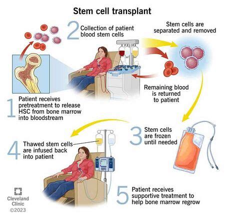 bone marrow transplant pcso|GERALDINE G. BAYANG Bone Marrow transplant patient PCSO .